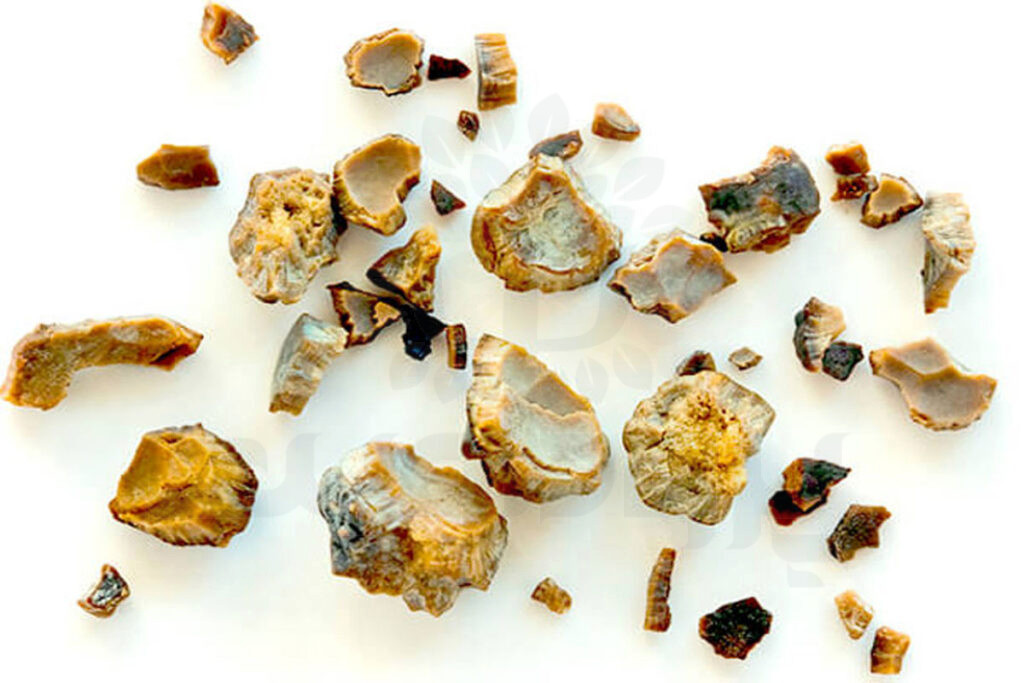 سنگ کلیه